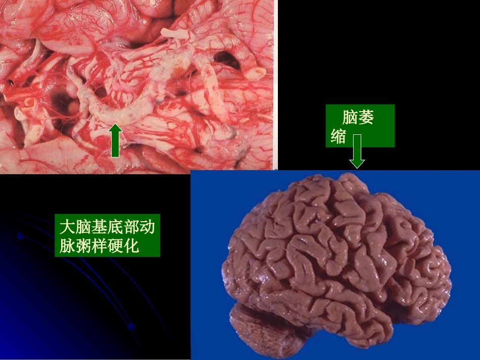 病理学动脉粥样硬化症中部分_第12页