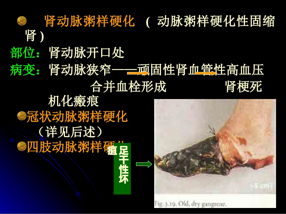 病理学动脉粥样硬化症中部分_第13页