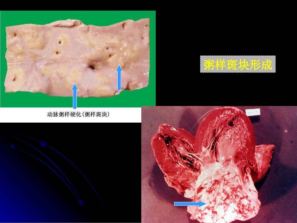 病理学动脉粥样硬化症中部分_第2页