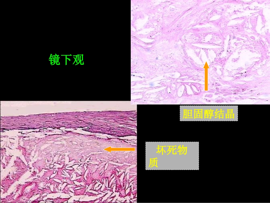 病理学动脉粥样硬化症中部分_第3页