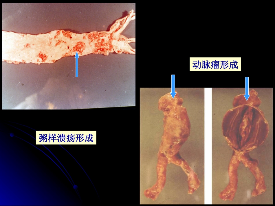 病理学动脉粥样硬化症中部分_第5页