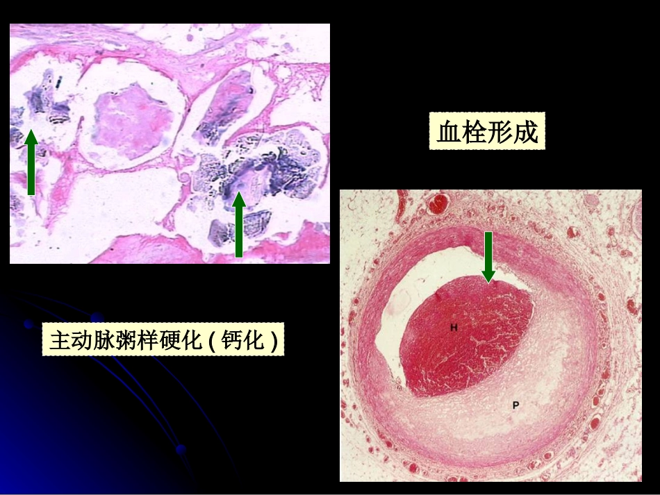 病理学动脉粥样硬化症中部分_第6页