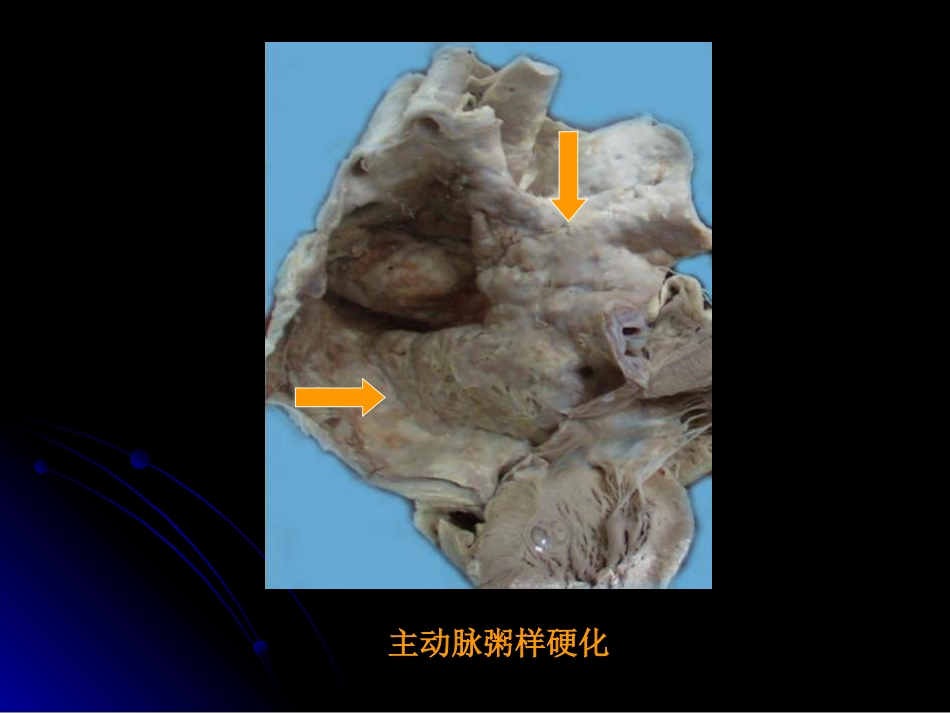 病理学动脉粥样硬化症中部分_第8页