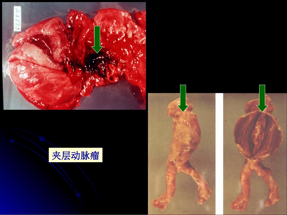 病理学动脉粥样硬化症中部分_第9页