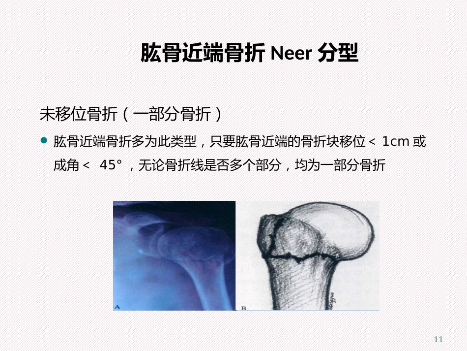 肱骨近端骨折分型及治疗_第11页
