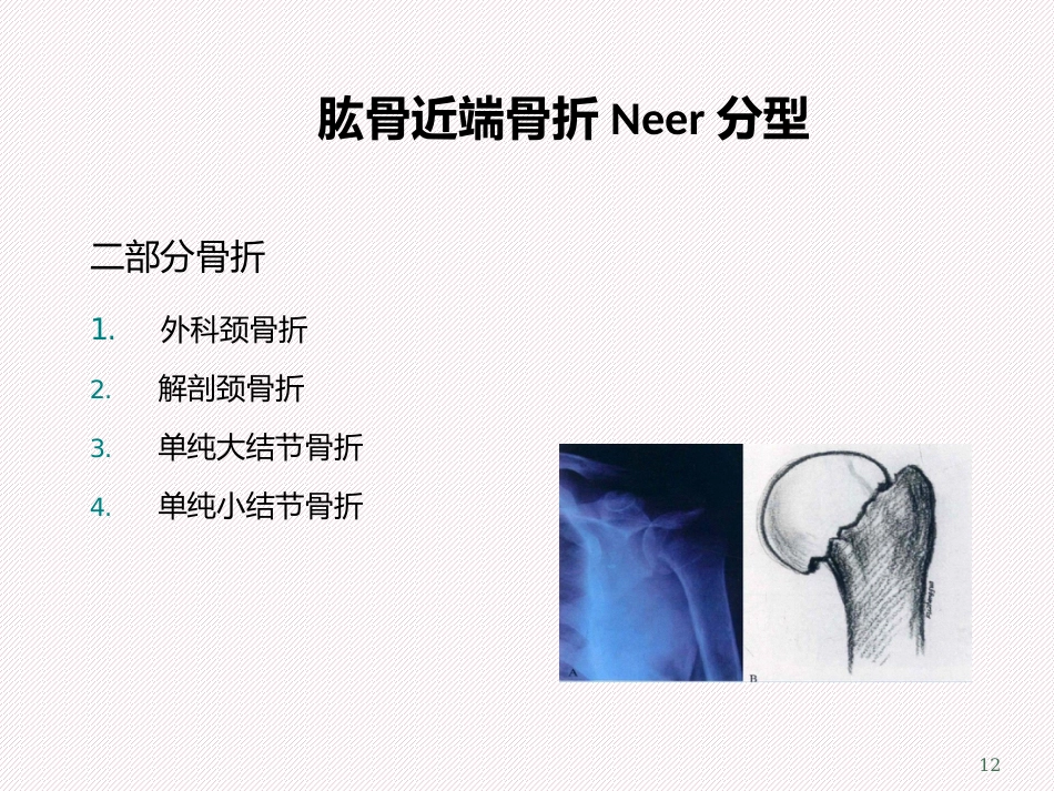 肱骨近端骨折分型及治疗_第12页