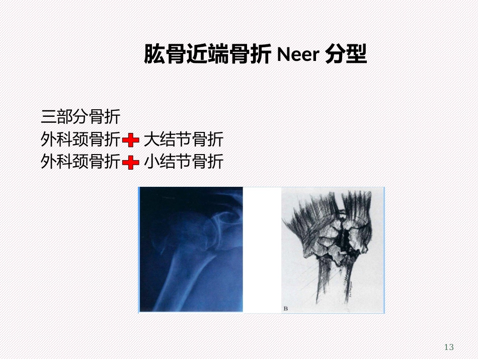 肱骨近端骨折分型及治疗_第13页