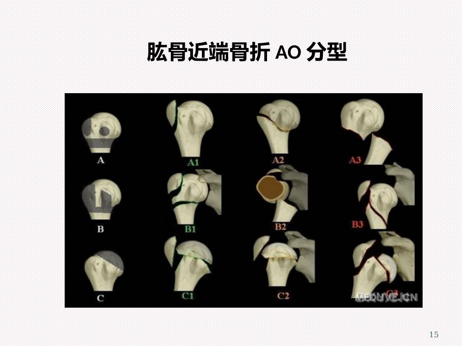 肱骨近端骨折分型及治疗_第15页