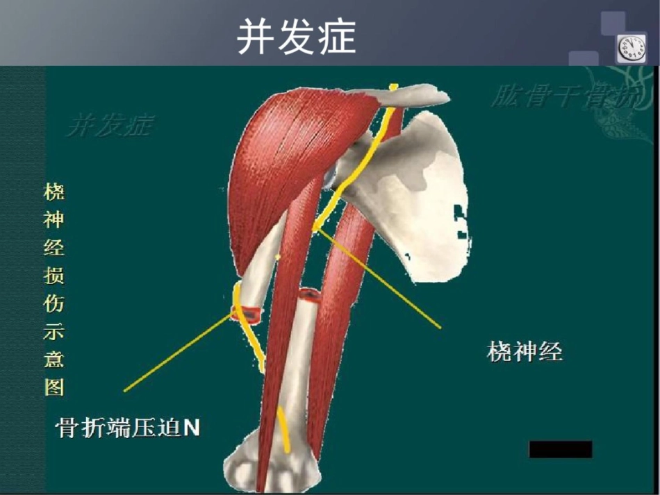 肱骨干骨折讲解_第12页