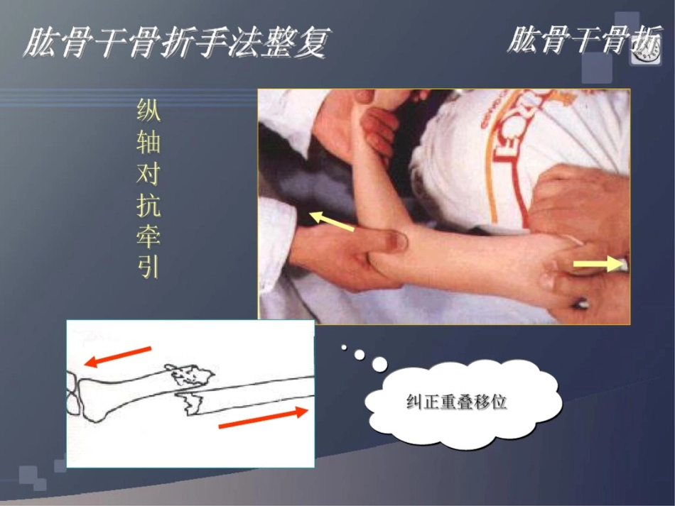 肱骨干骨折讲解_第15页