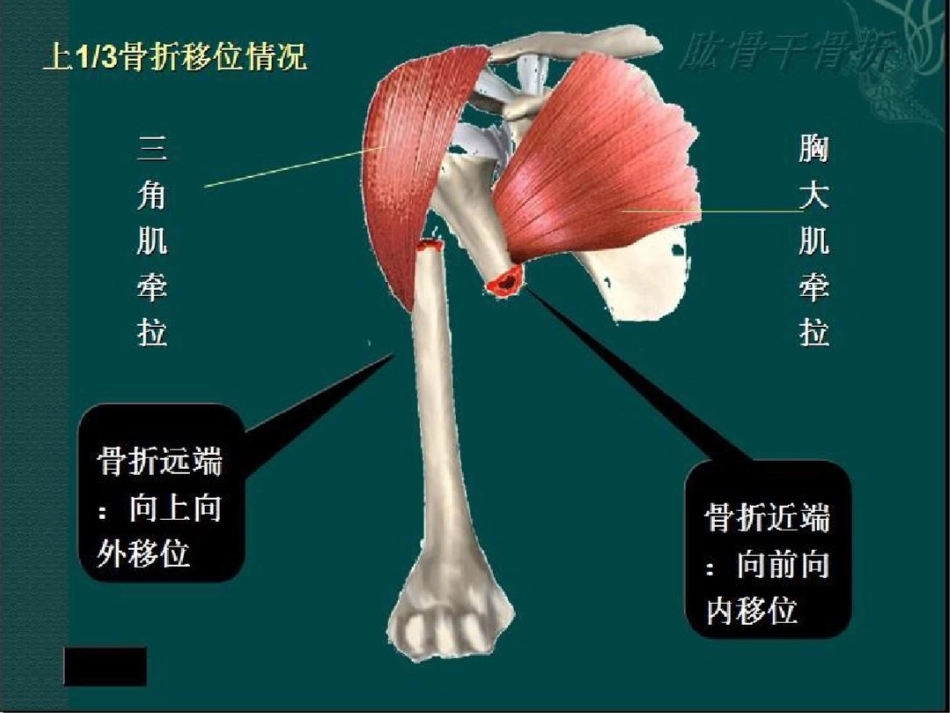 肱骨干骨折讲解_第7页
