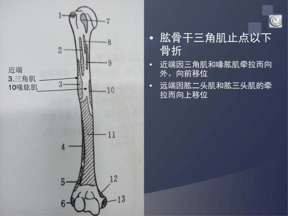 肱骨干骨折讲解_第8页