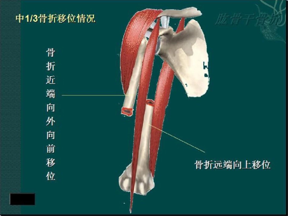 肱骨干骨折讲解_第9页