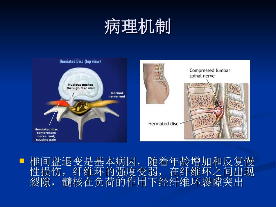 五年制讲稿——腰腿痛和颈肩痛_第14页