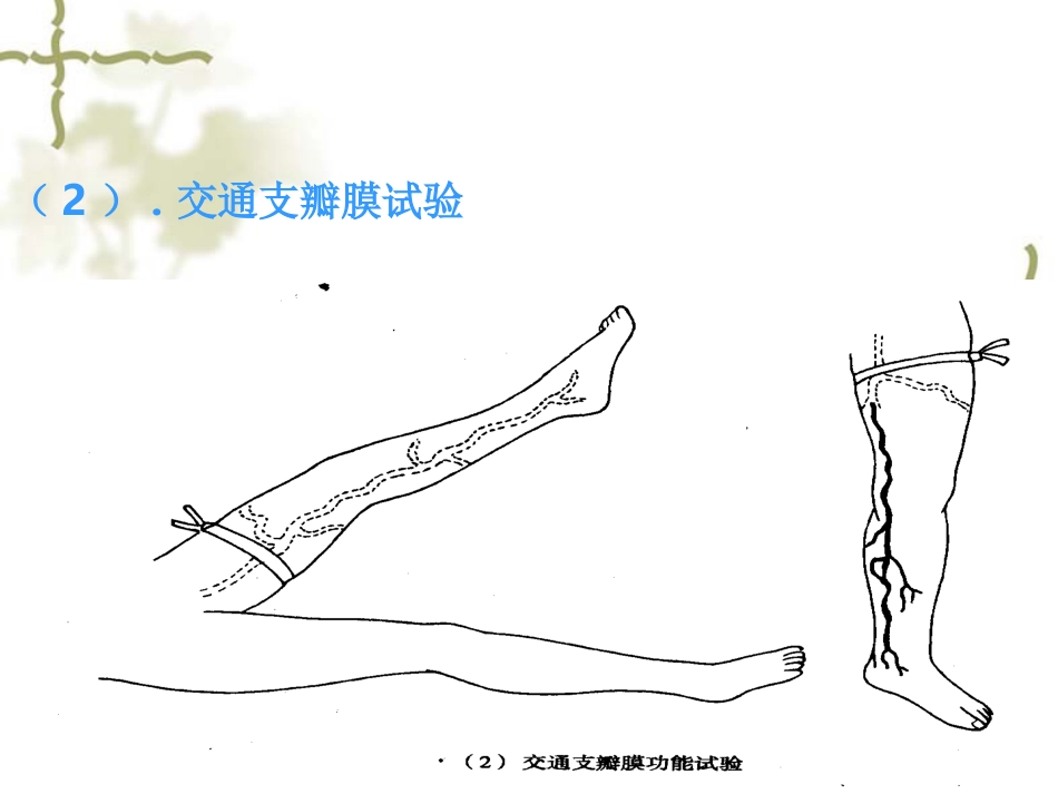 下肢静脉曲张病人的护理_第14页