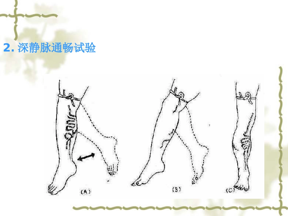下肢静脉曲张病人的护理_第15页