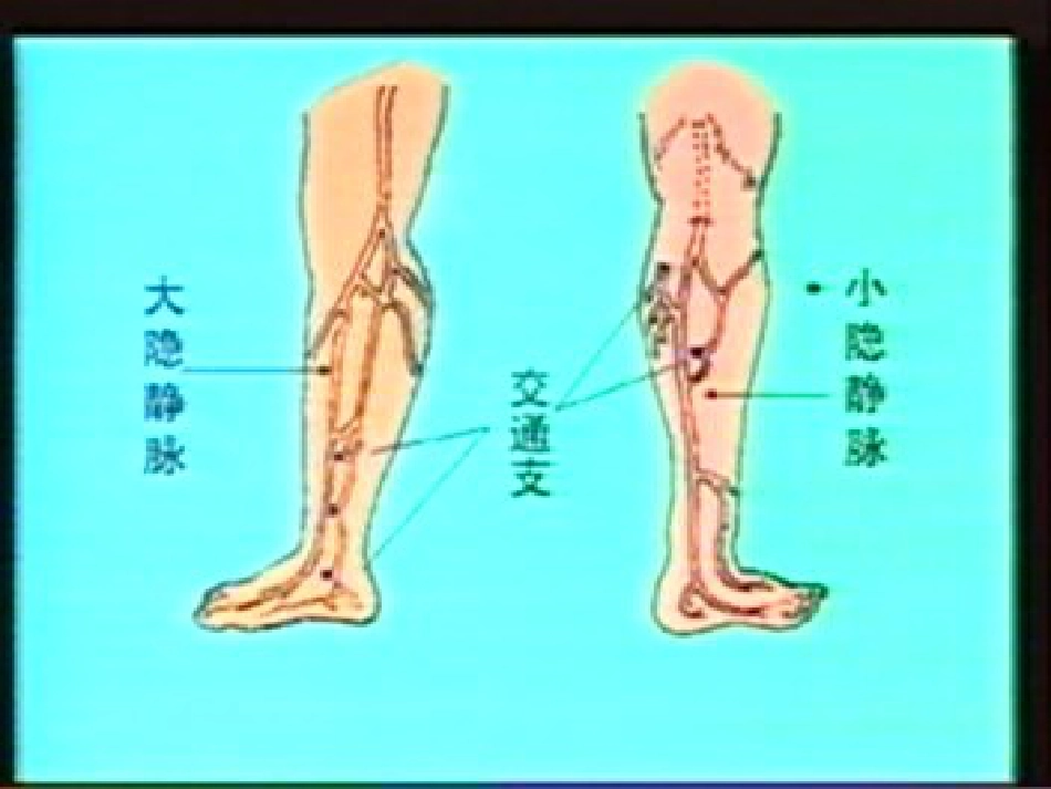 下肢静脉曲张病人的护理_第4页