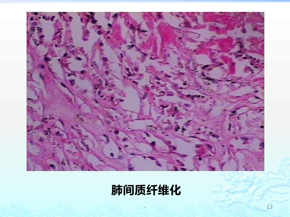病理学 矽肺 肺心病 ARDS 肺癌ppt课件_第13页