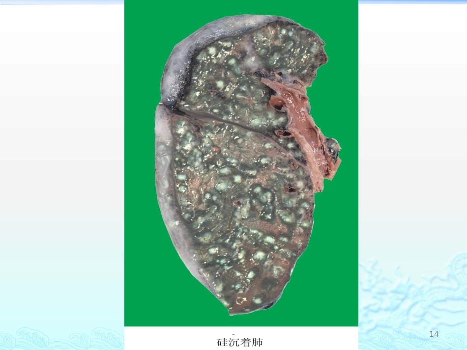 病理学 矽肺 肺心病 ARDS 肺癌ppt课件_第14页