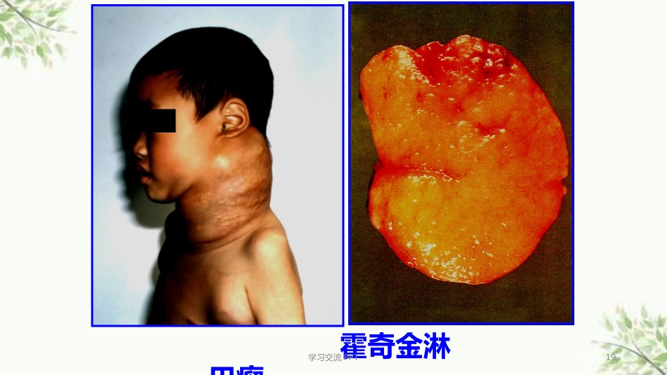 病理学淋巴造血系统疾病医学PPT课件_第15页