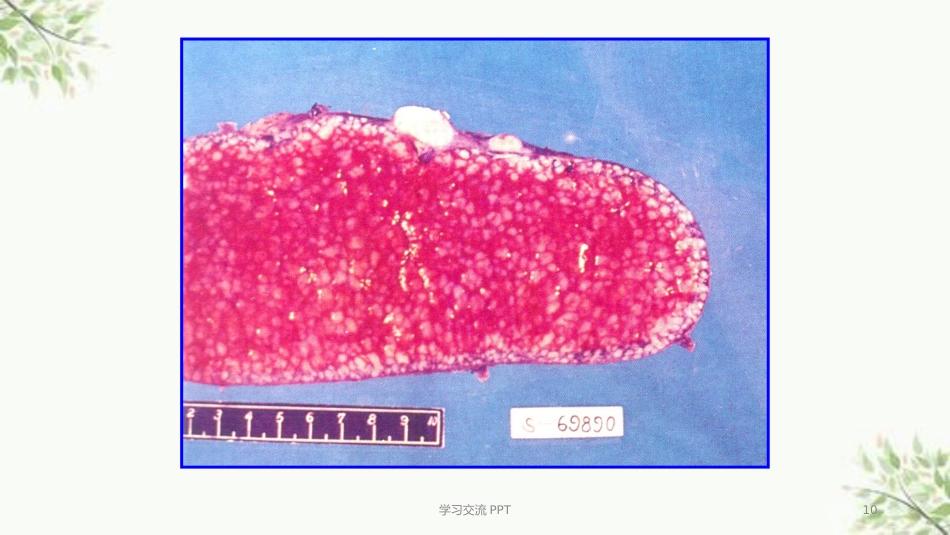 病理学淋巴造血系统疾病医学PPT课件_第9页