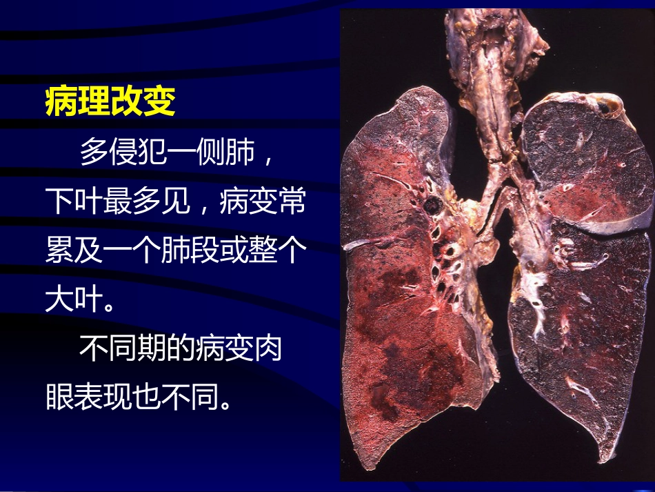 病理学呼吸系统疾病(一)_第9页