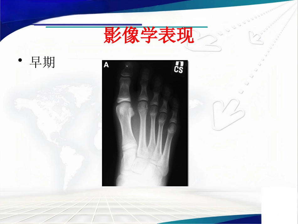 Freiberg病的诊断治疗_第10页
