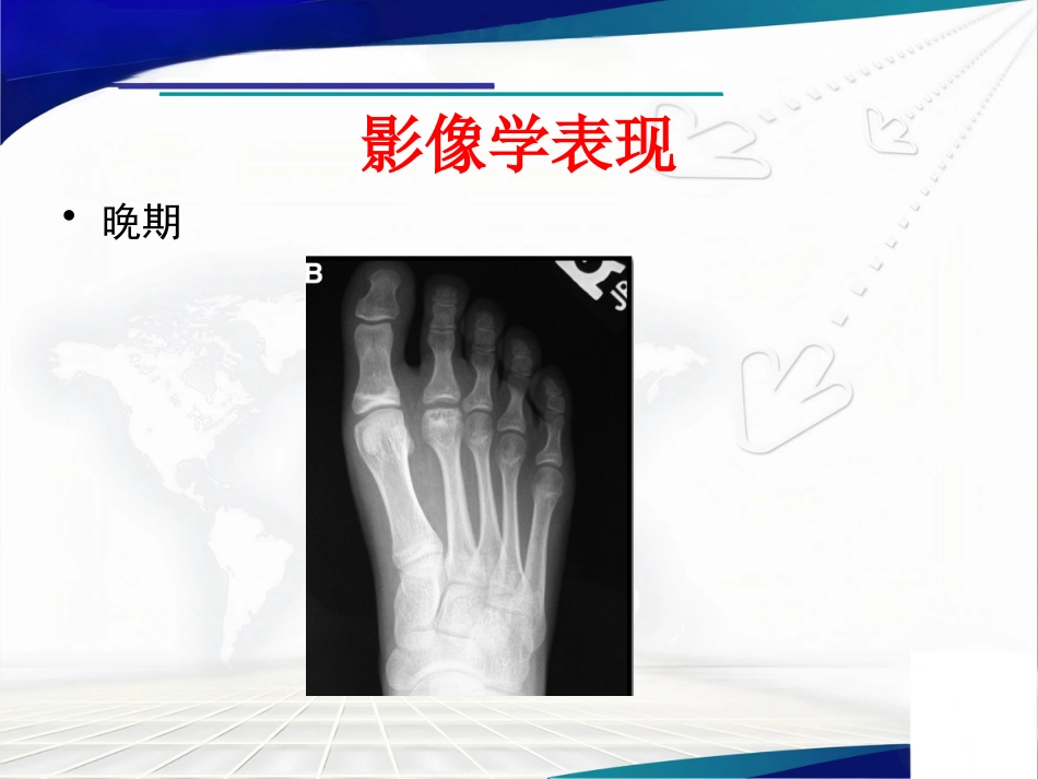 Freiberg病的诊断治疗_第11页