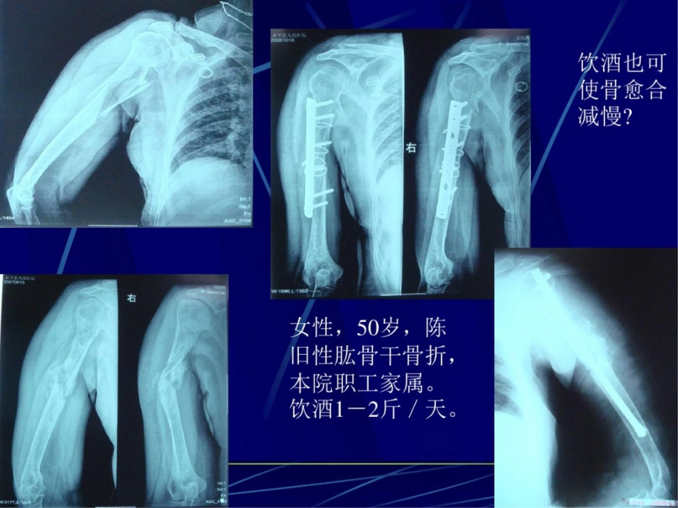肱骨干骨折保守治疗的技巧与陷阱_第10页
