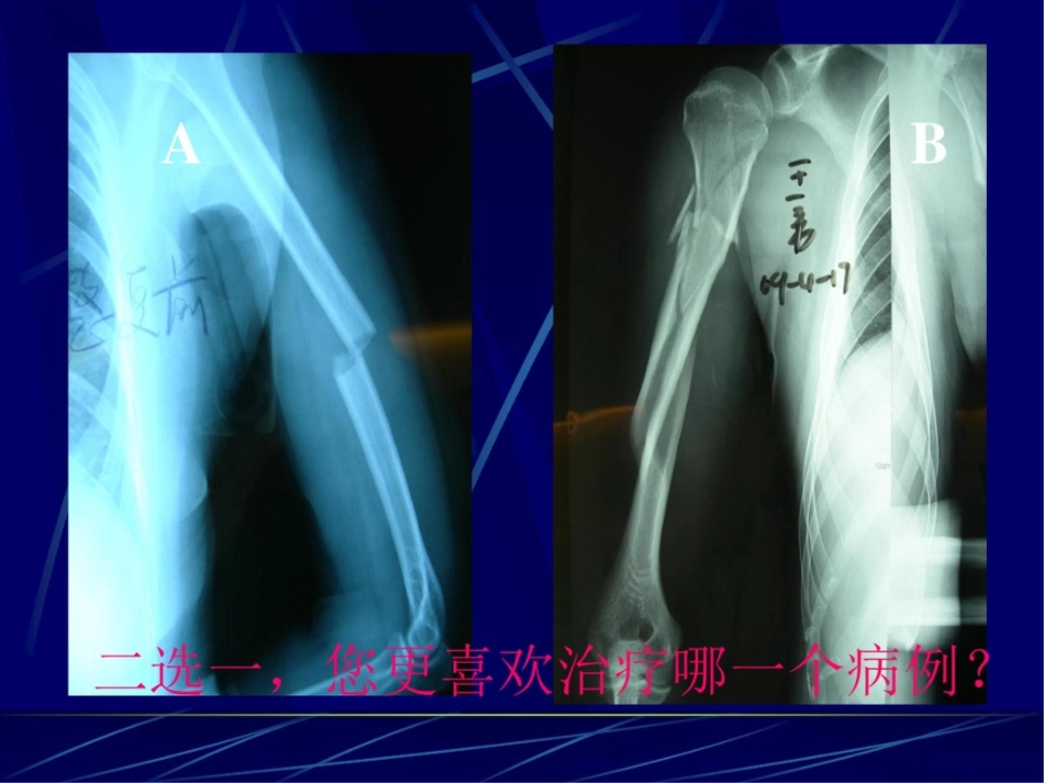 肱骨干骨折保守治疗的技巧与陷阱_第11页