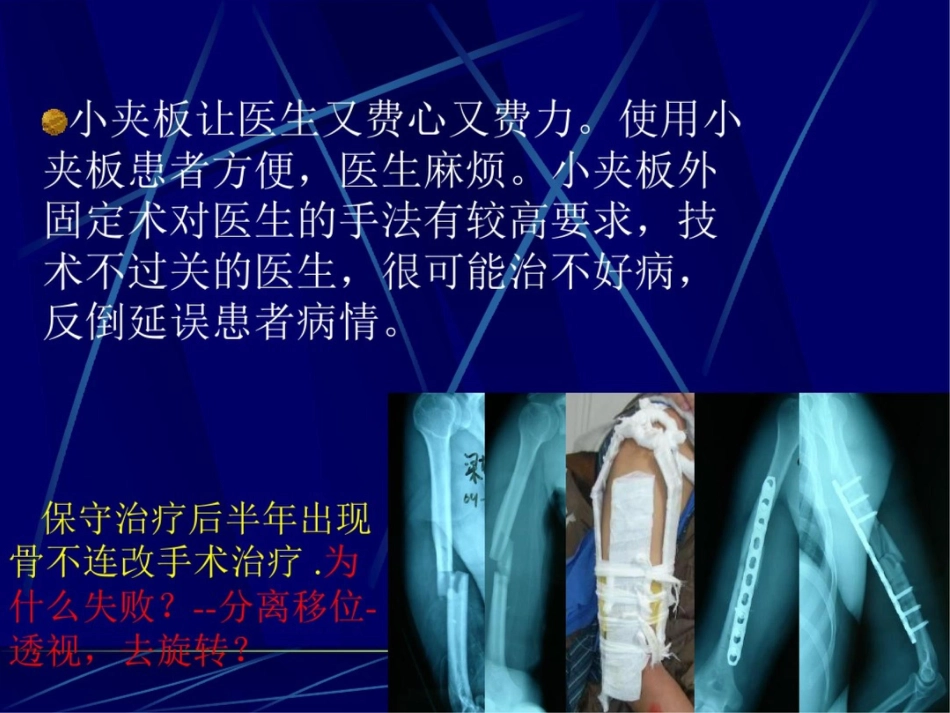 肱骨干骨折保守治疗的技巧与陷阱_第8页