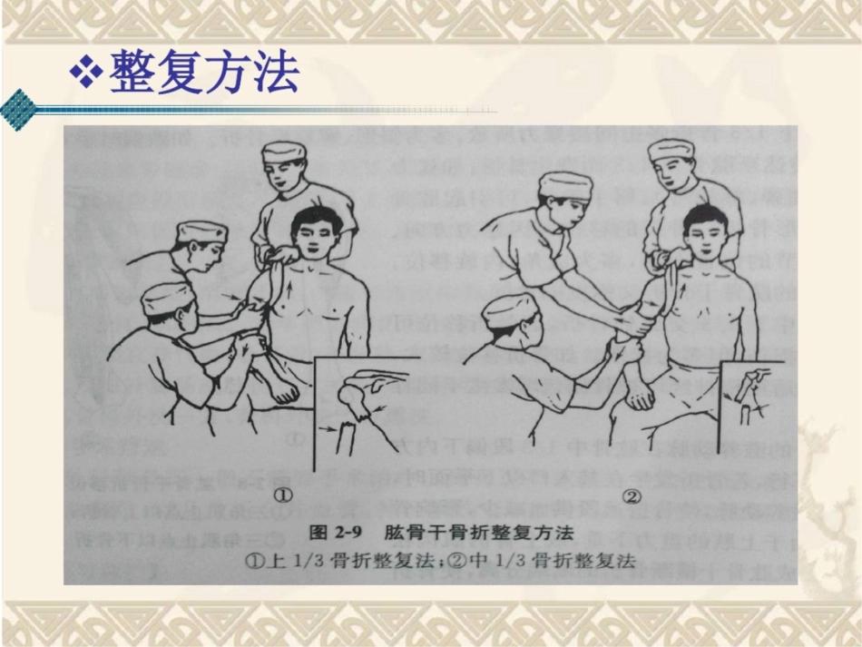 肱骨干骨折(课件)._第13页