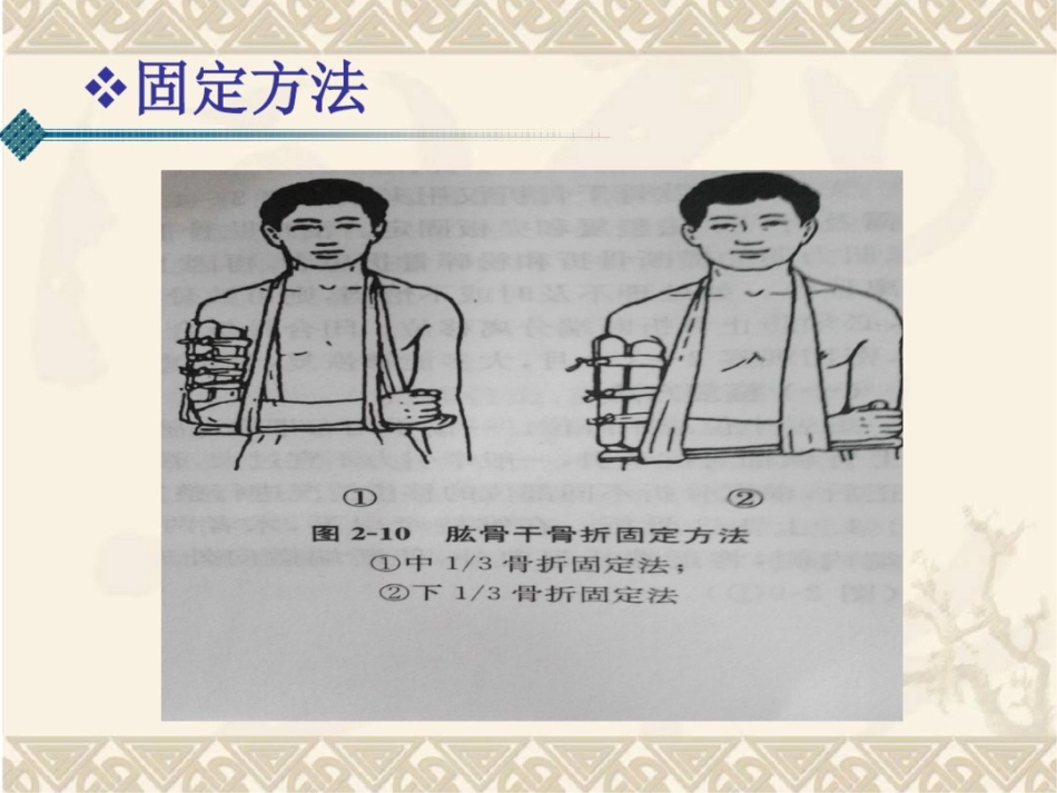 肱骨干骨折(课件)._第15页