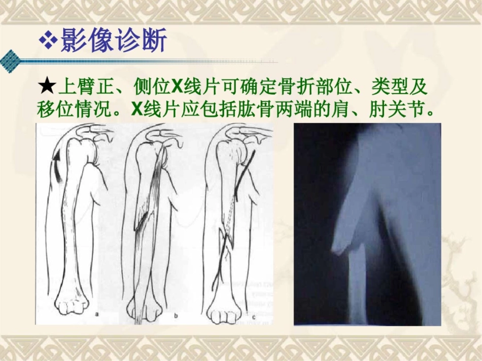 肱骨干骨折(课件)._第9页