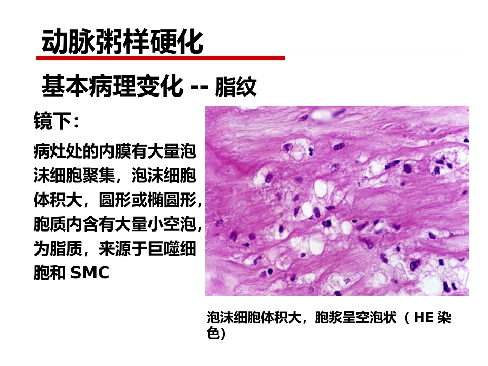 病理学 心血管系统疾病_第10页