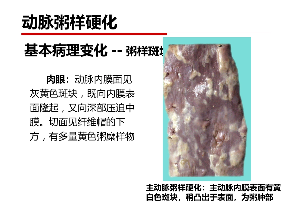 病理学 心血管系统疾病_第12页