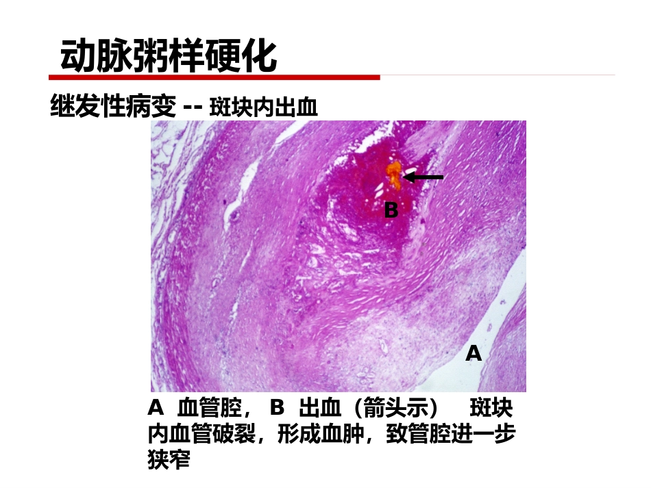 病理学 心血管系统疾病_第15页