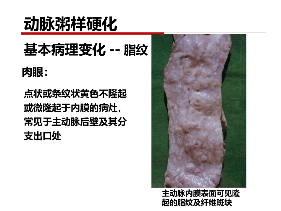 病理学 心血管系统疾病_第9页