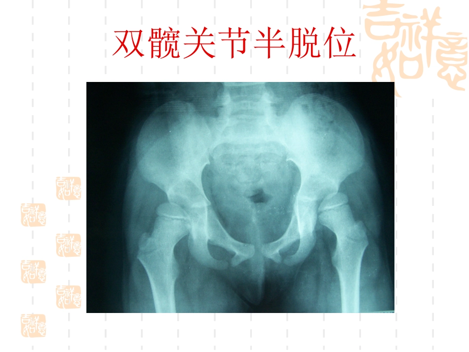 发育性髋关节脱位_第11页