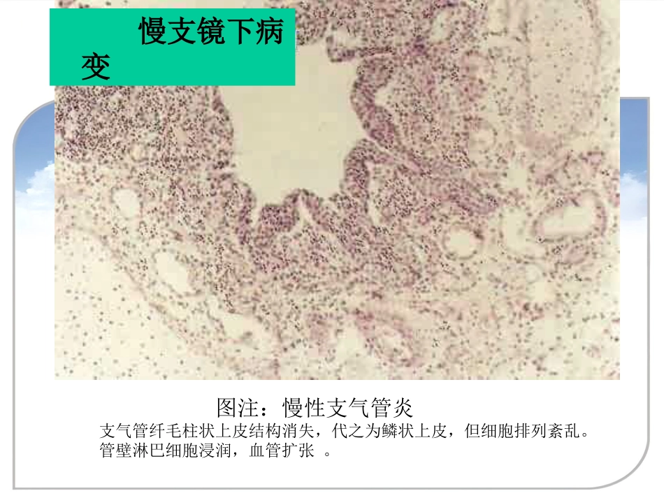 病理学课件PPT 呼吸系统疾病_第15页