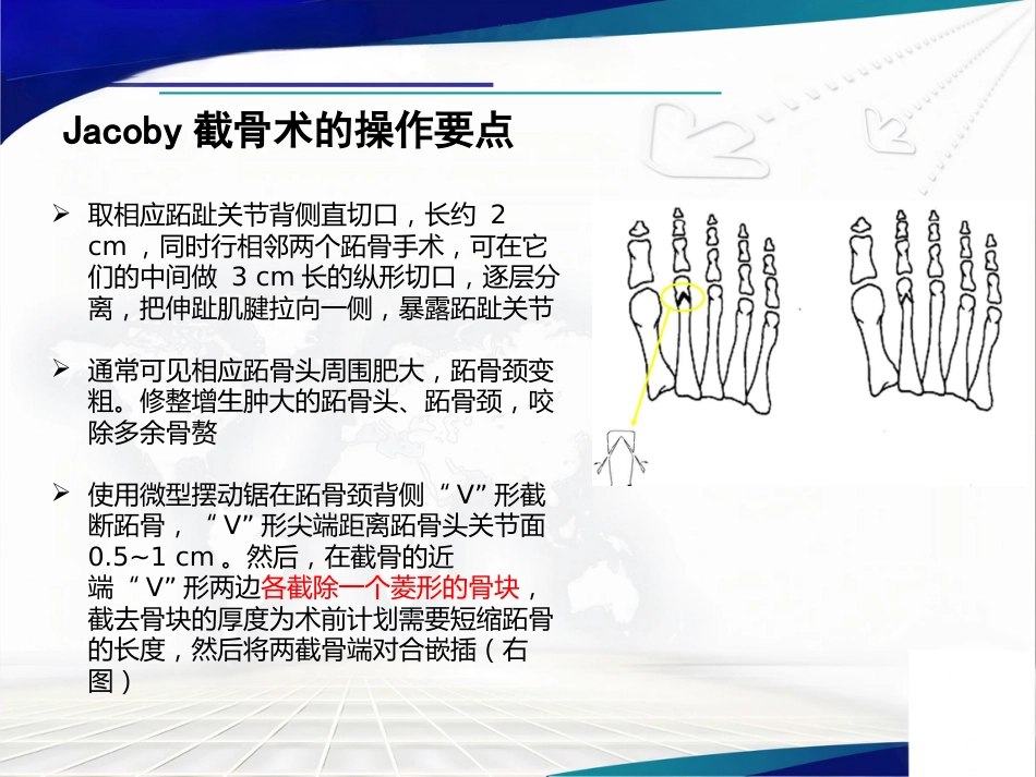 Weil截骨术与Jacoby截骨术_第11页