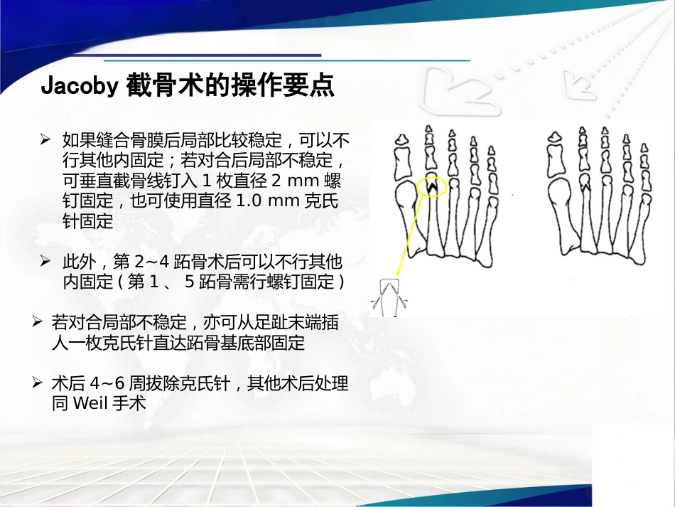 Weil截骨术与Jacoby截骨术_第12页