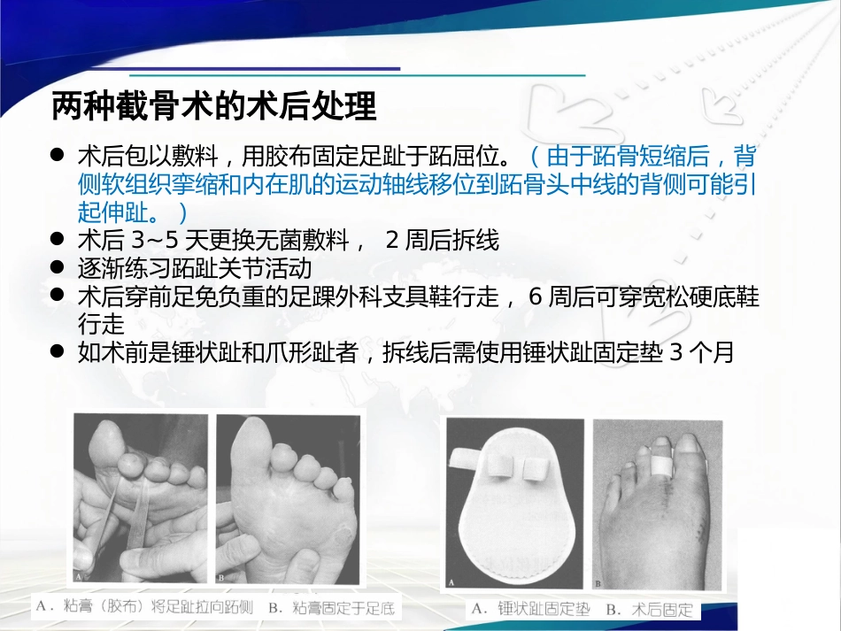 Weil截骨术与Jacoby截骨术_第13页