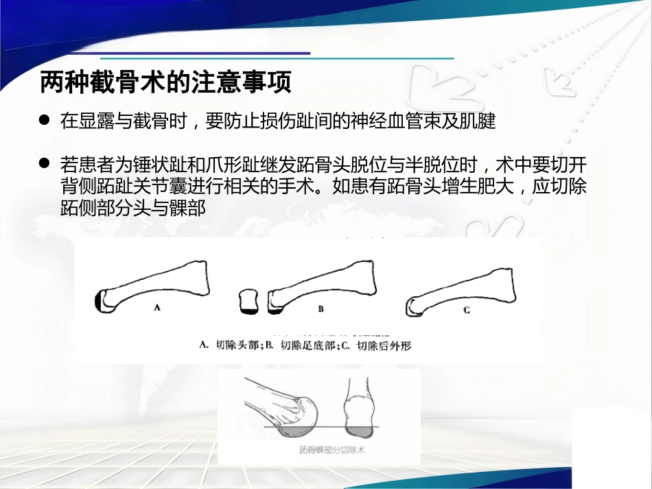 Weil截骨术与Jacoby截骨术_第14页