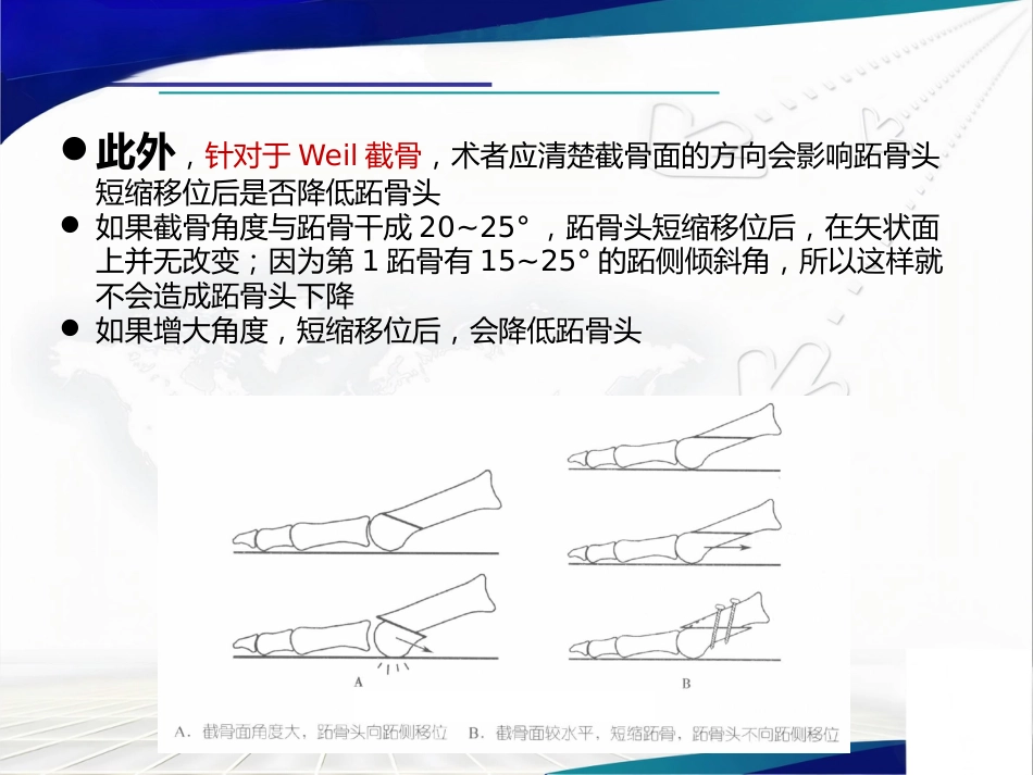 Weil截骨术与Jacoby截骨术_第15页