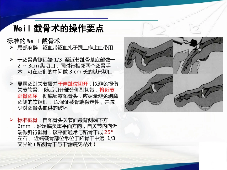 Weil截骨术与Jacoby截骨术_第6页