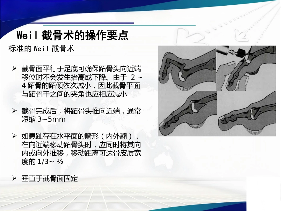 Weil截骨术与Jacoby截骨术_第7页