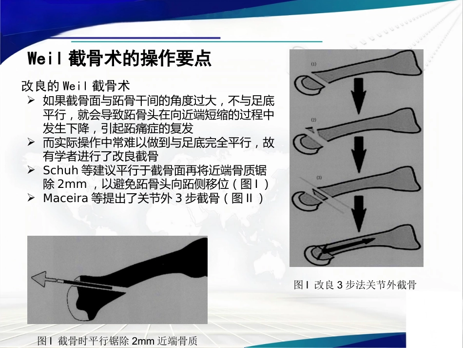 Weil截骨术与Jacoby截骨术_第8页