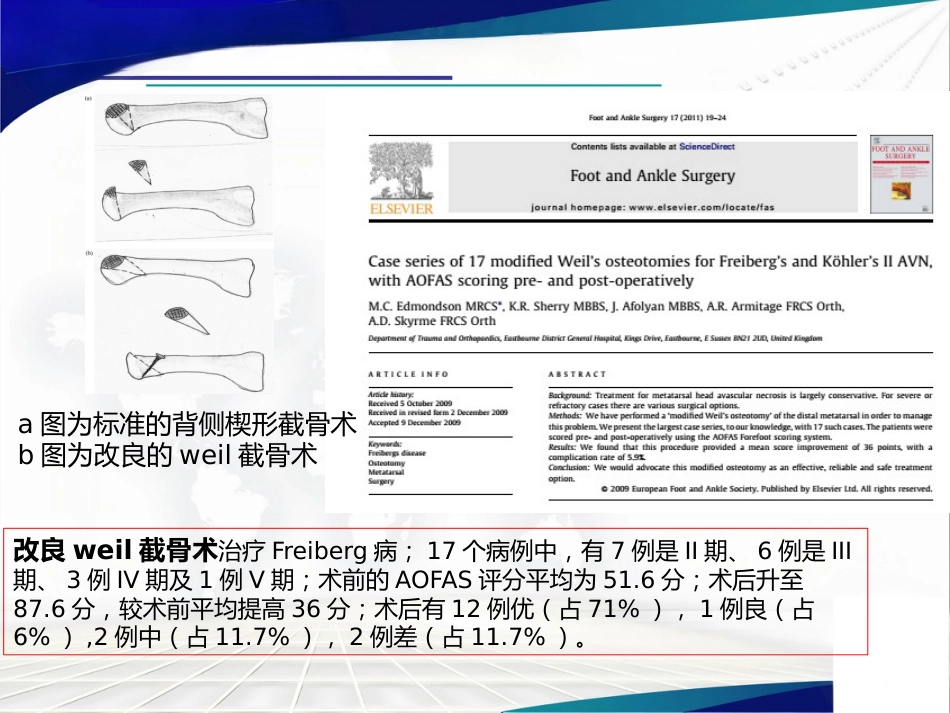 Weil截骨术与Jacoby截骨术_第9页