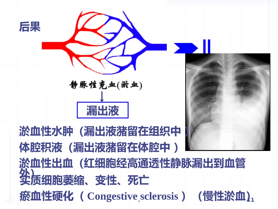 病理学局部血液循环障碍ppt课件_第11页